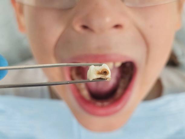 Best Emergency Dentist for Knocked-Out Tooth in Pinewood Estates, TX